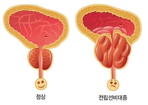 Rising Rates of Prostatic Hyperplasia Among Men in Their 20s and 30s
