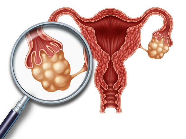 Is Hysterosalpingography (HSG) Mandatory for Fertility Testing?