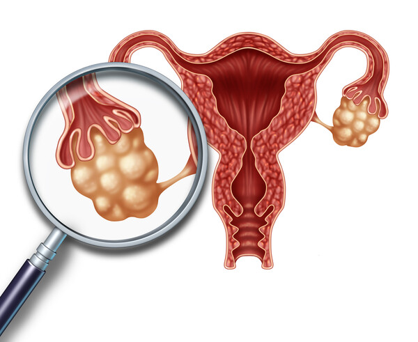 Is Hysterosalpingography (HSG) Mandatory for Fertility Testing?