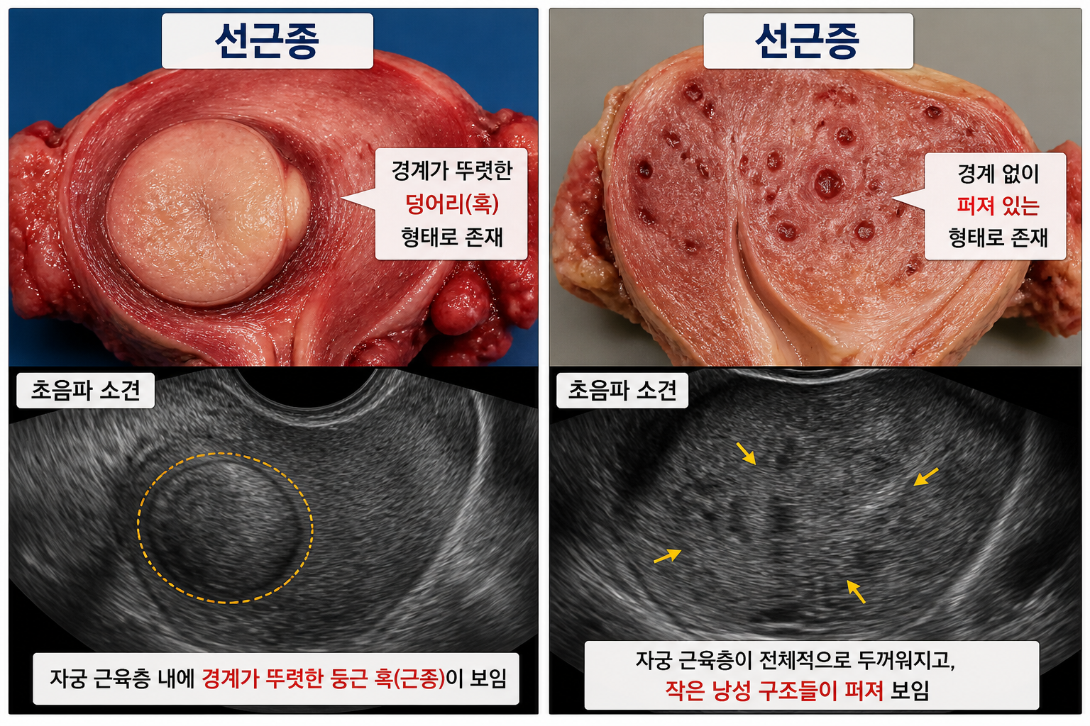 “Adenomyosis vs. Leiomyoma”: Why Distinguishing Between These Uterine Conditions is Key to Fertility Success