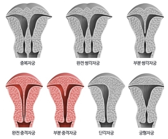 “The Tilting Stage”: Why Uterine Anatomy is the Foundation of Fertility