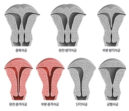 “The Tilting Stage”: Why Uterine Anatomy is the Foundation of Fertility