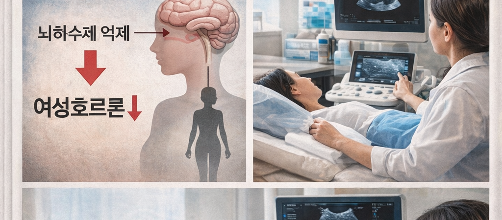 Relugolix: A Breakthrough in Symptom Management or Just a Temporary Pause for the Uterus?