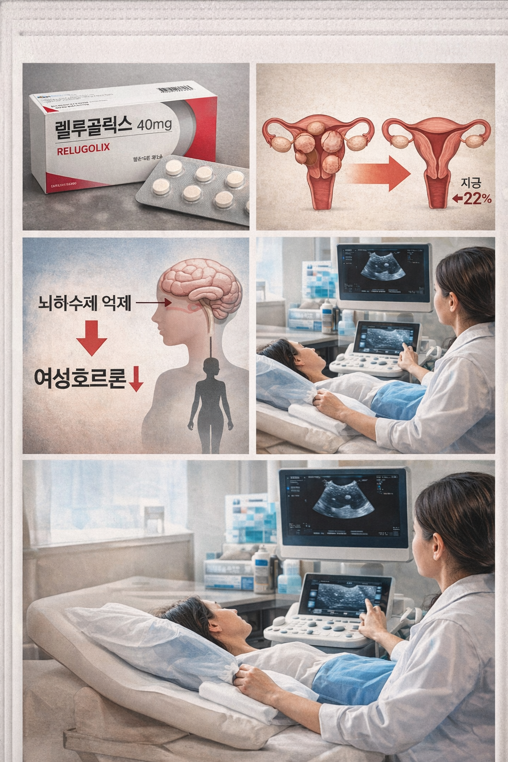 Relugolix: A Breakthrough in Symptom Management or Just a Temporary Pause for the Uterus?