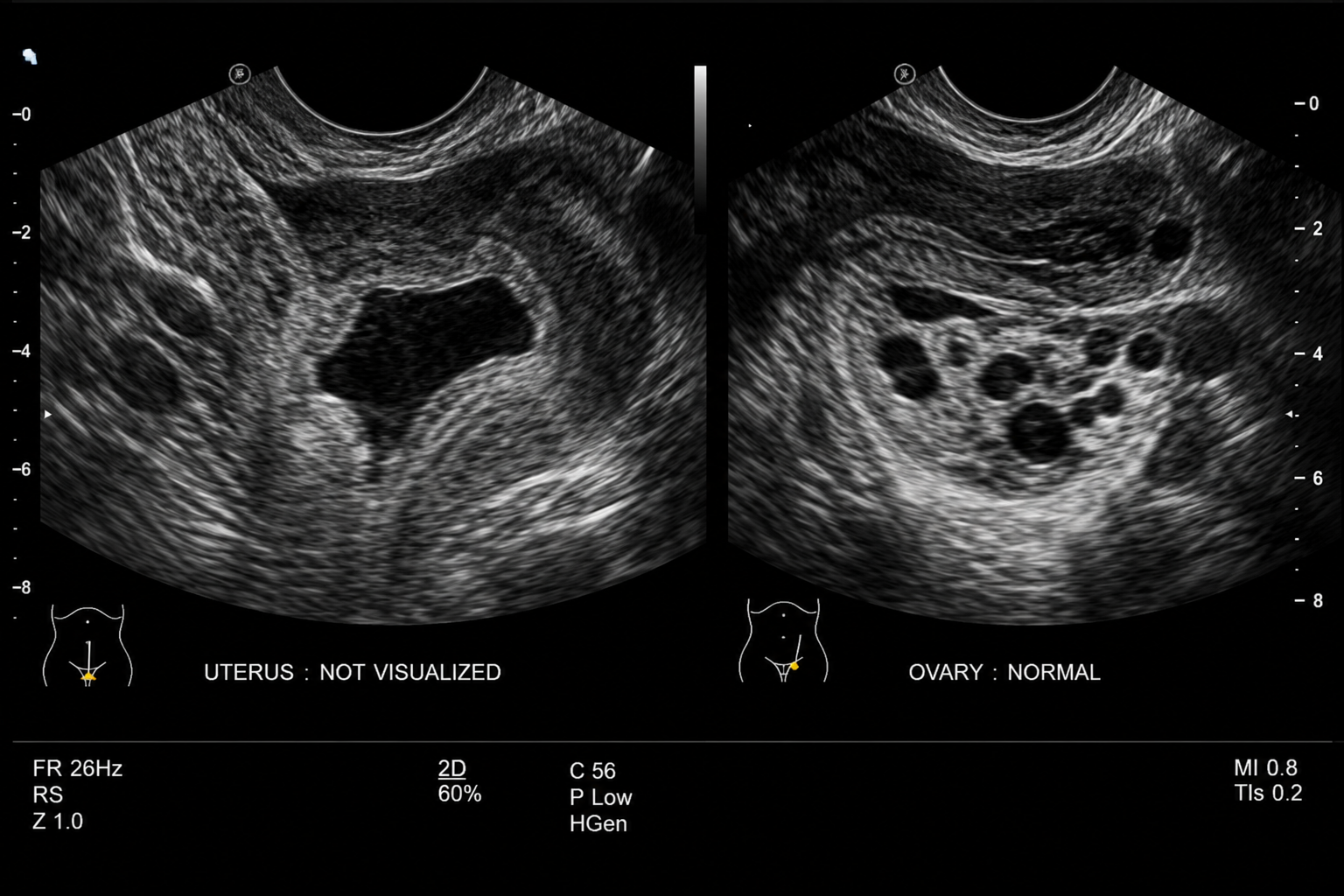 “I Thought It Was Supposed to Hurt”… Born Without a Vagina or with a Very Short One?