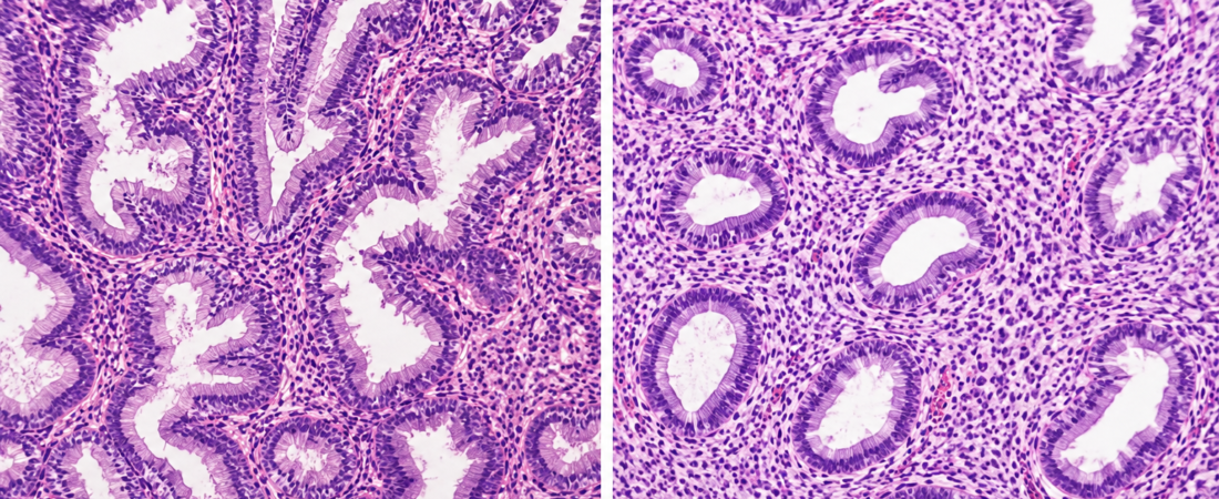 “The Era of Relying Only on Microscopes Is Over”… Predicting Cancer Risk in Endometrial Hyperplasia via Genetic Analysis