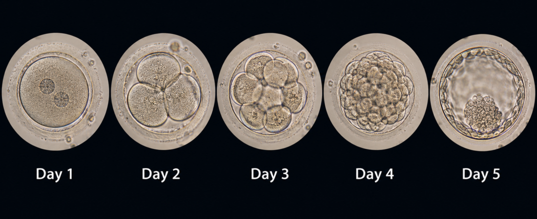 “With Only a Single Embryo, Should We Cultivate It to Day 5?”… A Study Shaking Up Long-Standing IVF Assumptions